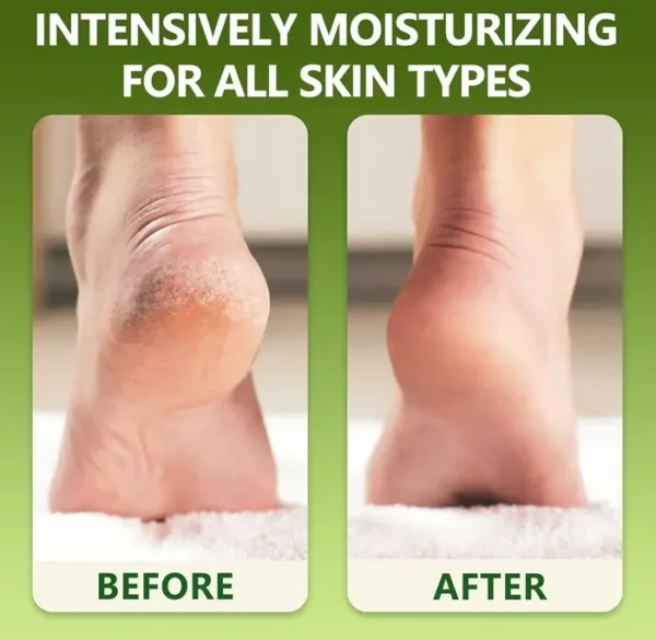 Tea Tree Foot Cream - Restore Dry Feet - 6.35 oz.