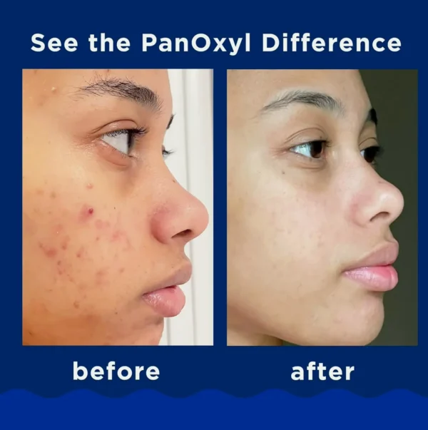 PanOxyl Pimple Wash BP 10% Strength, 5.5 Oz